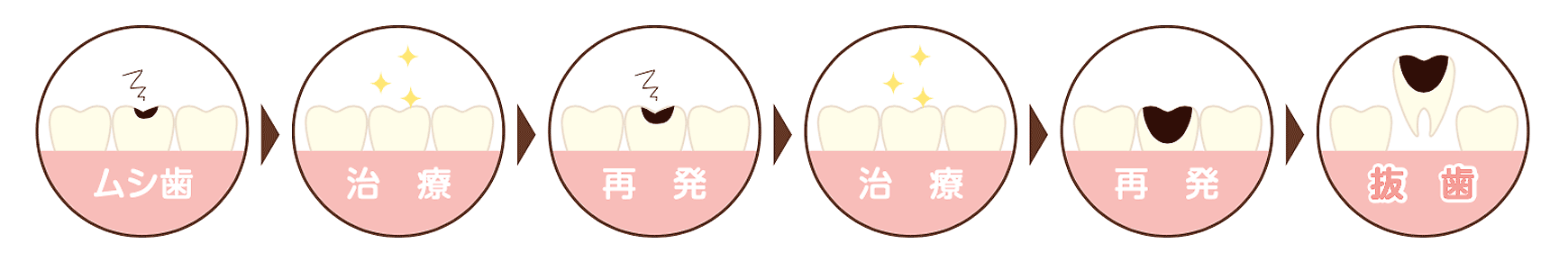 MI治療フロー