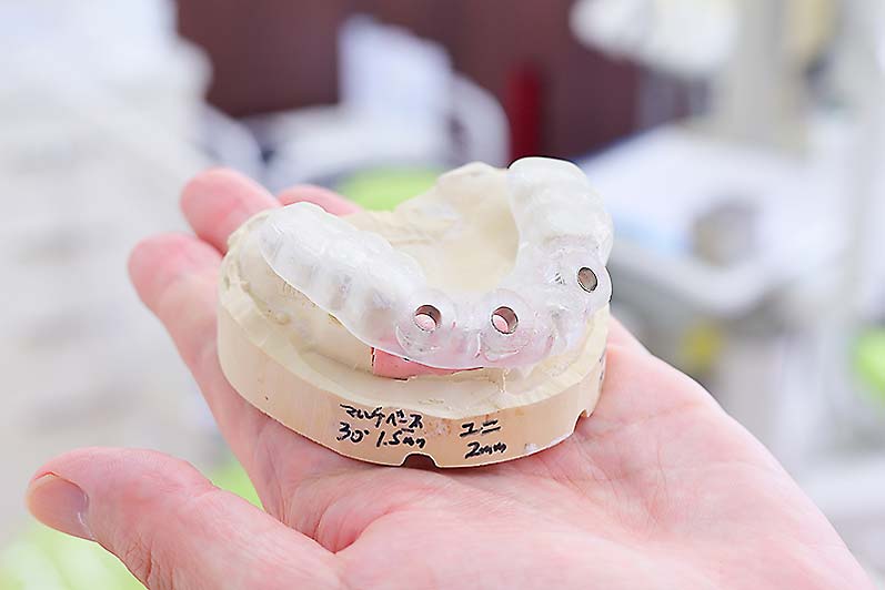 安全性を高めたインプラント治療